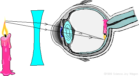 kurzsicht_brille.gif